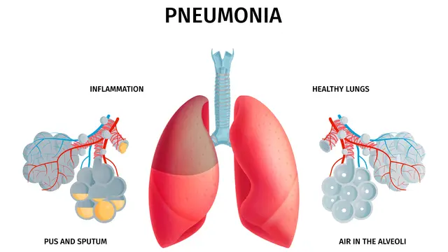 coronatalk.org, Jakarta Pneumonia merupakan penyakit yang ternyata bisa menyebabkan kematian. Organisasi Kesehatan Dunia (World Health Organization/WHO) pada tahun 2021 mengungkapkan hampir 740 ribu kematian pada anak di bawah lima tahun disebabkan oleh pneumonia.