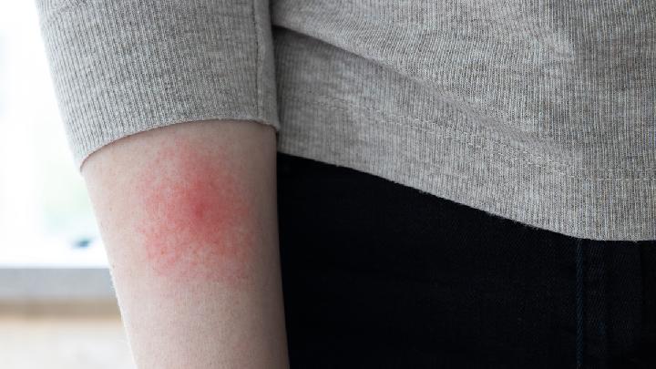 Dampak Jangka Panjang Penyakit Lyme jika Tak Segera Diobati